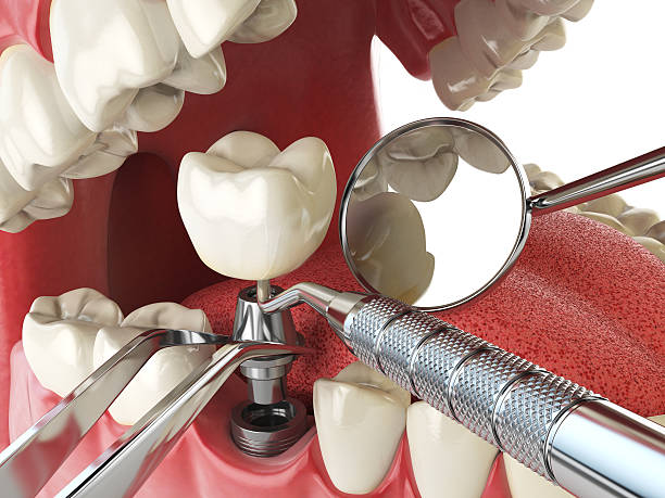 Best Emergency Root Canal Treatment in Roanoke, VA