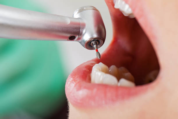 Best Emergency Dentist for Lost Fillings or Crowns in Roanoke, VA
